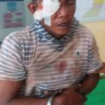 Robet (40) pelaku penggelapan sepeda motor mengalami luka-luka akibat dipermak warga.